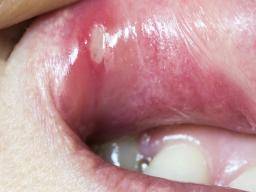 aphthous ulcers throat