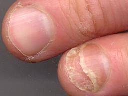 Nail fungal infection Causes treatment and symptoms