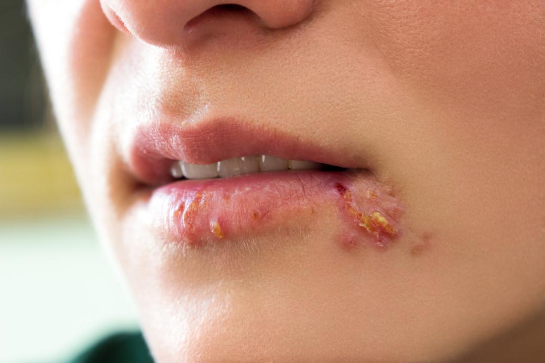 Herpes in females Symptoms, diagnosis, and treatment