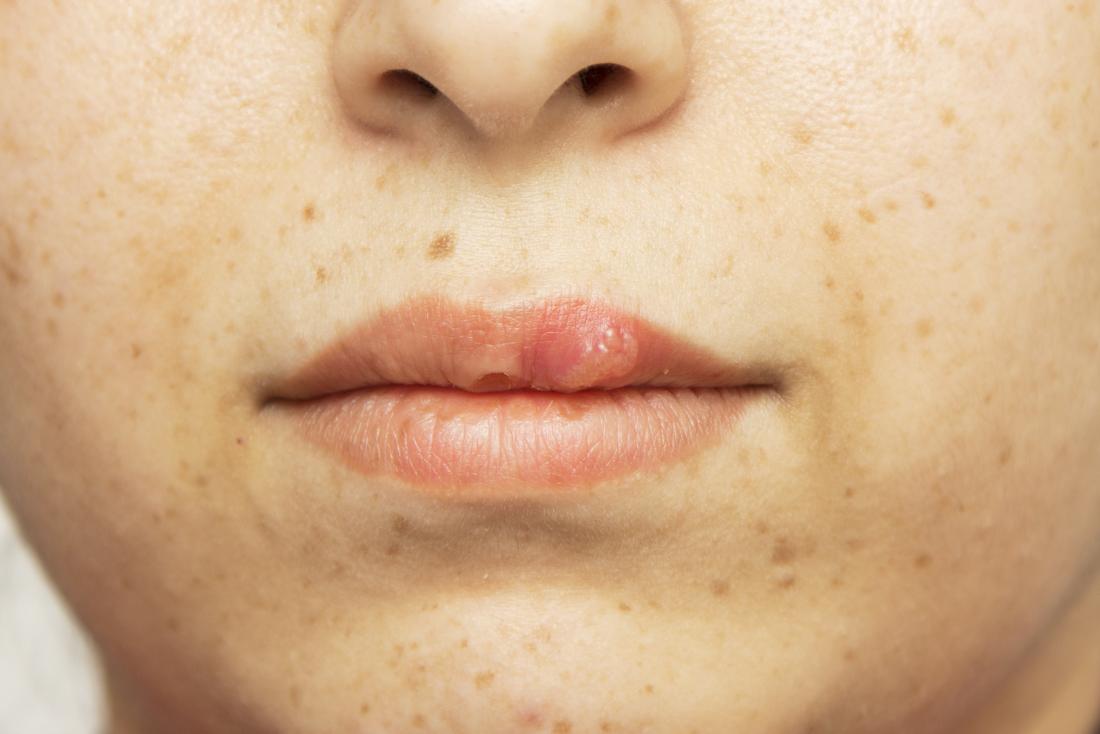 Herpes In Females Symptoms Diagnosis And Treatment