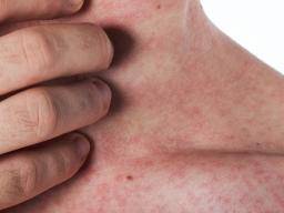 How To Treat Prickly Heat Rash On Neck | Allergy Trigger