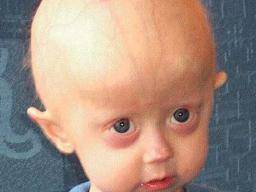 Progeria Causes Symptoms And Treatment