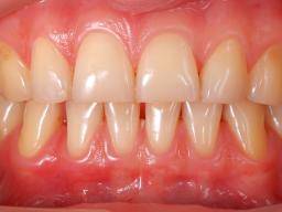 Receding Gums Causes Symptoms And Treatment