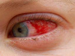 Conjunctival Xerosis Meaning In Hindi