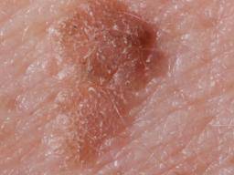 Actinic Keratosis Pictures Causes And Prevention