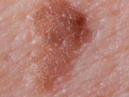 Seborrheic Keratosis Symptoms Treatment And Causes