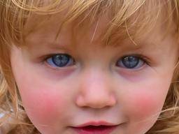 reservation cylinder valse Erythema infectiosum, slapped cheek syndrome, or fifth disease