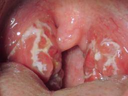 Implicaties experimenteel lading Strep throat: Causes, diagnosis, and treatments