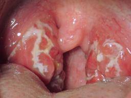 Chronic Sore Throat Causes And When To See A Doctor