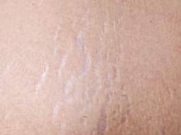 I have developed strange horizontal scar-like marks on my inner