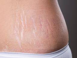 4 ways to reduce the appearance of your stretch marks - Etre Vous