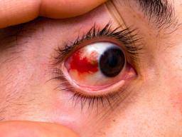 Causes Of Sore Eyes Treatments And Home Remedies