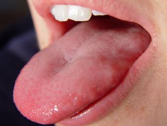 Treatment for tongue papillae