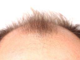 Baldness: How close are we to a cure?