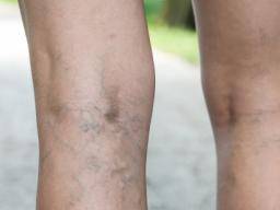 Varicose (spider) veins: Treatment, causes, symptoms, and more