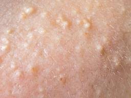 White Bumps On The Skin Caused By Milia 