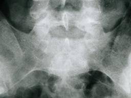Ankylosing spondylitis: X-ray and imaging techniques
