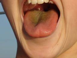What Is Black Hairy Tongue  Dental Health Services Houston Texas
