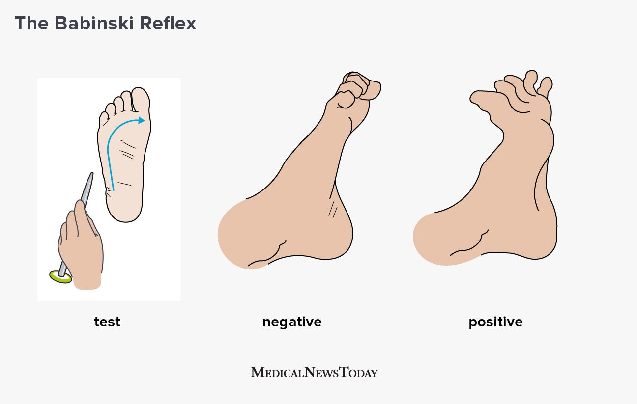 What is the Babinski reflex?