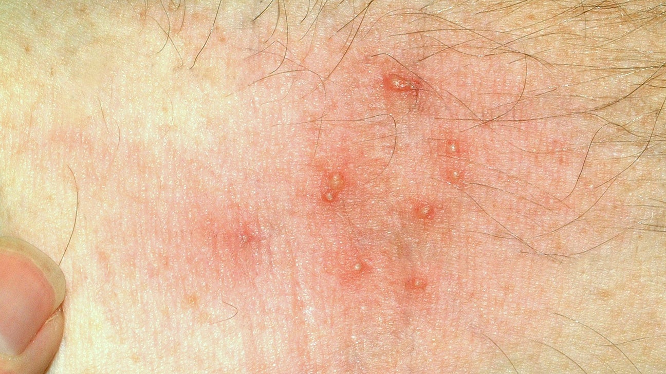 Mite Bites: Symptoms, Treatment, And Different Bites
