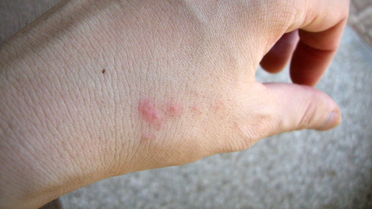 Bug Bites and Stings: Pictures, Identification, Treatment