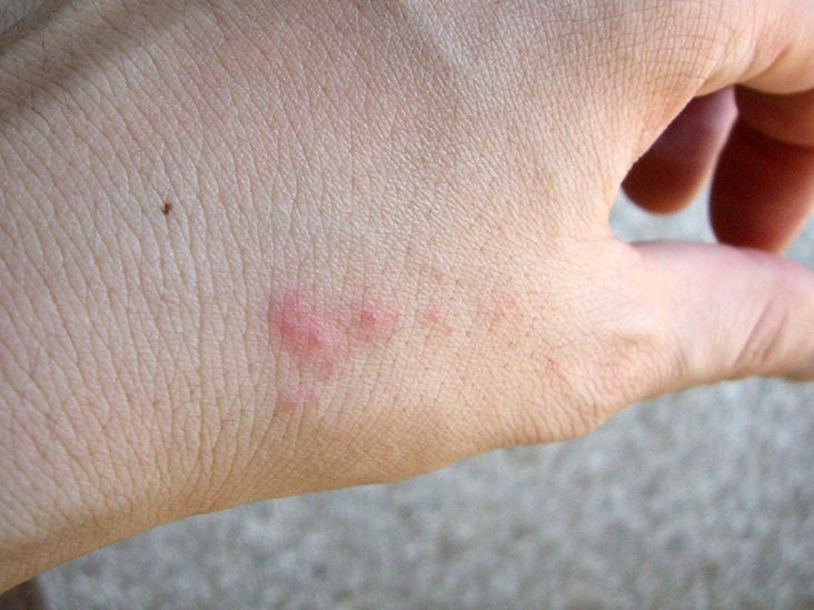 little red dots on skin bug bites