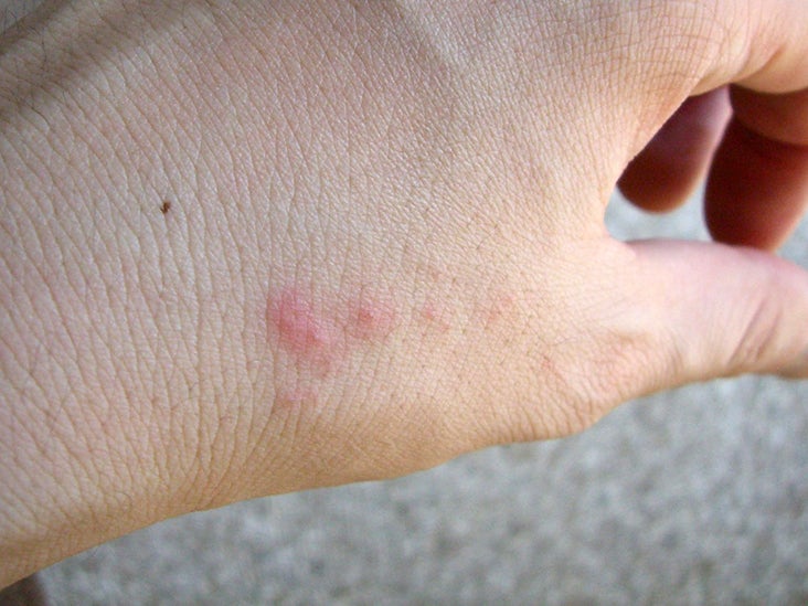 bug bites that itch and burn