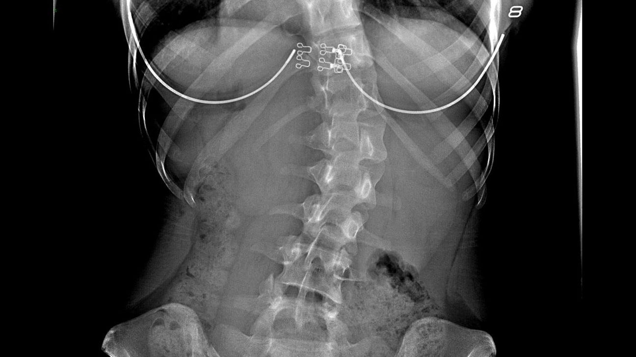 How does your thoracic spine affect your neck? - Physio Professionals