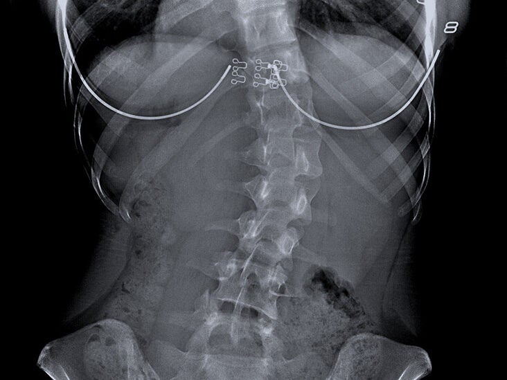 Can A Vertebral Fusion Be Reversed? Exploring Spinal Restoration Options