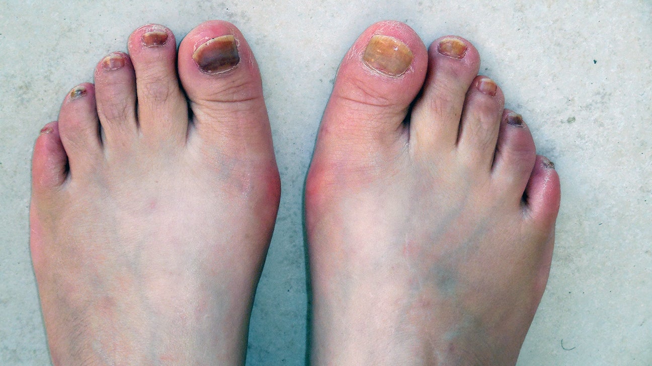 Nail bed injury: Pictures, types, and treatments