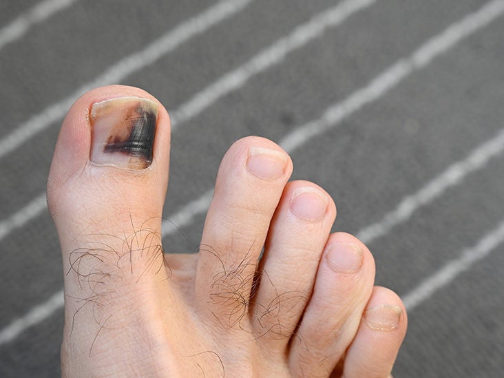 Common Toenail Injuries in Athletes  Sports Medicine Review
