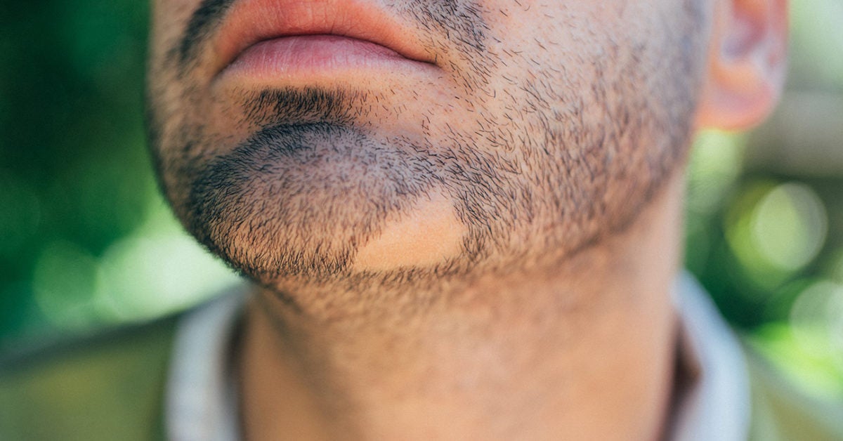 Bald patch in beard: Causes and treatments