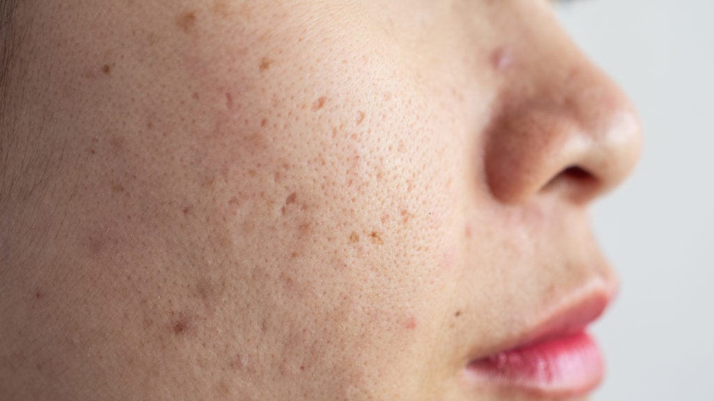 What Are Dark Spots?