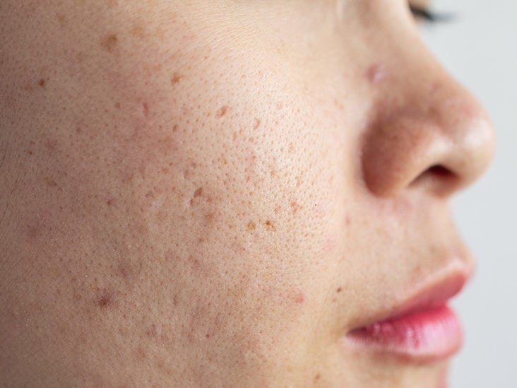 Hyperpigmentation Acne Causes And Treatment