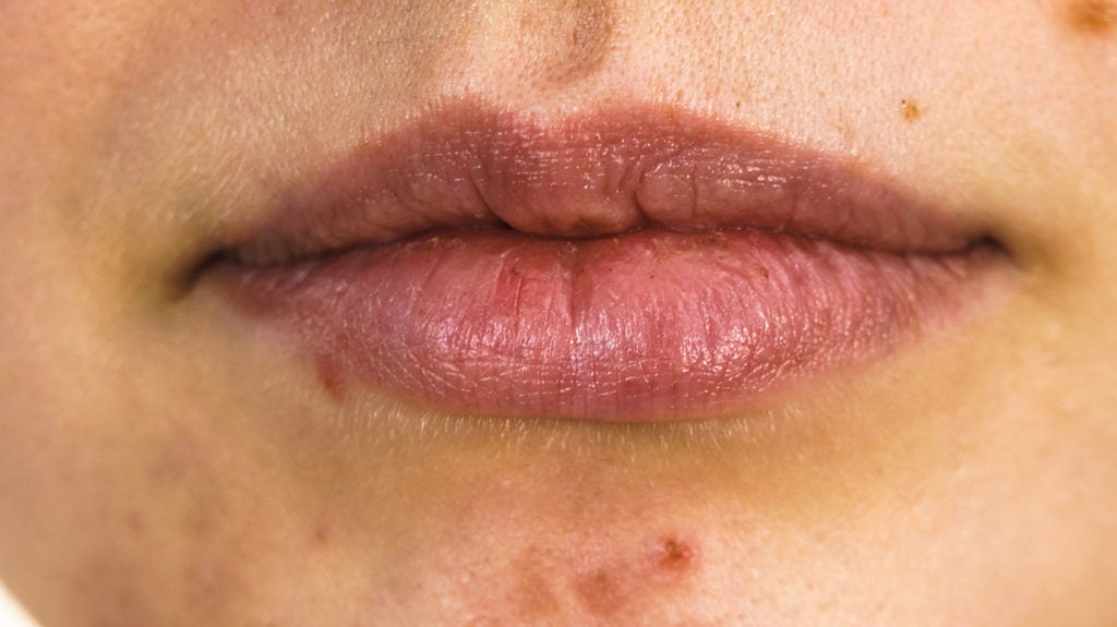 Acne Around Mouth Causes Prevention And Treatment