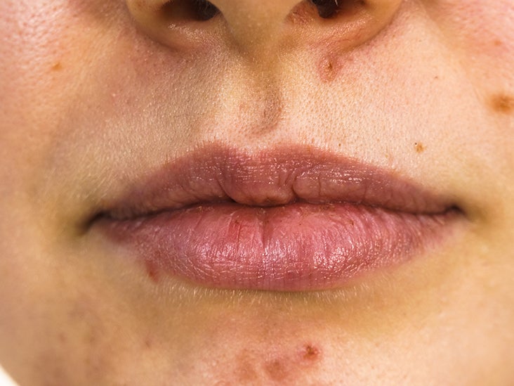 Acne around mouth: Causes, prevention, and treatment