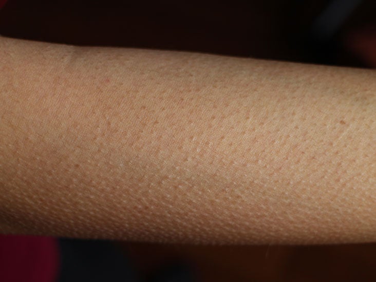 goosebumps-on-the-skin-causes-and-symptoms