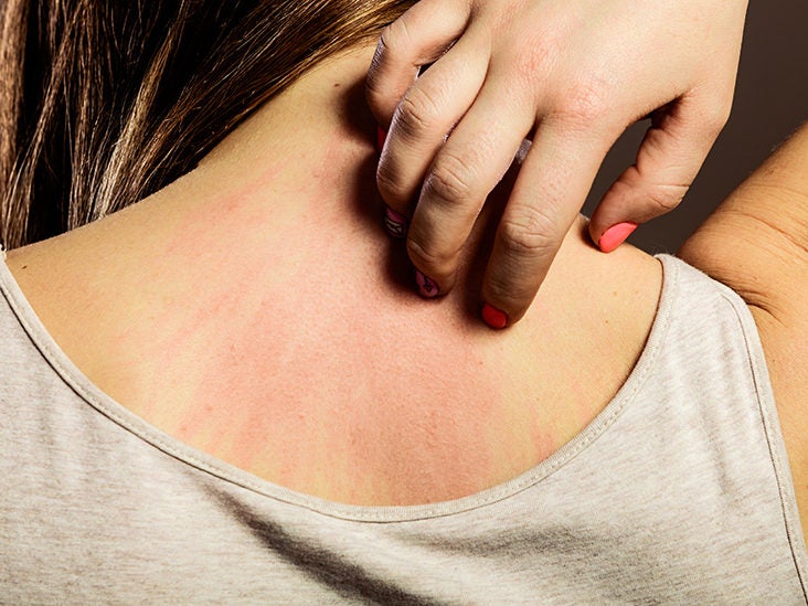 Waking up with scratches: Causes and treatment