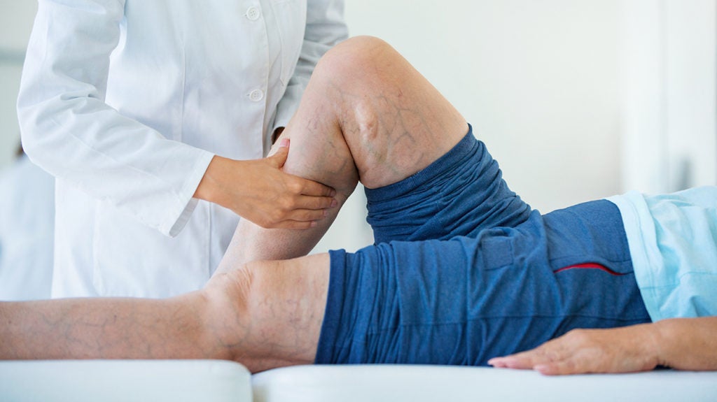 Deep vein thrombosis: Definition, symptoms, and treatment