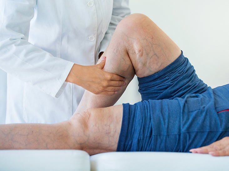 Deep vein thrombosis: Definition, symptoms, and treatment