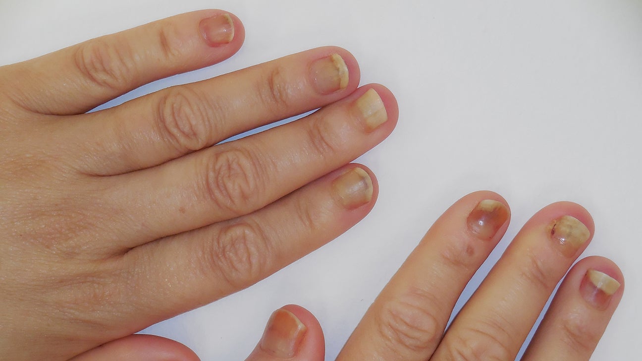Nail Bed Injury Pictures Types And Treatments