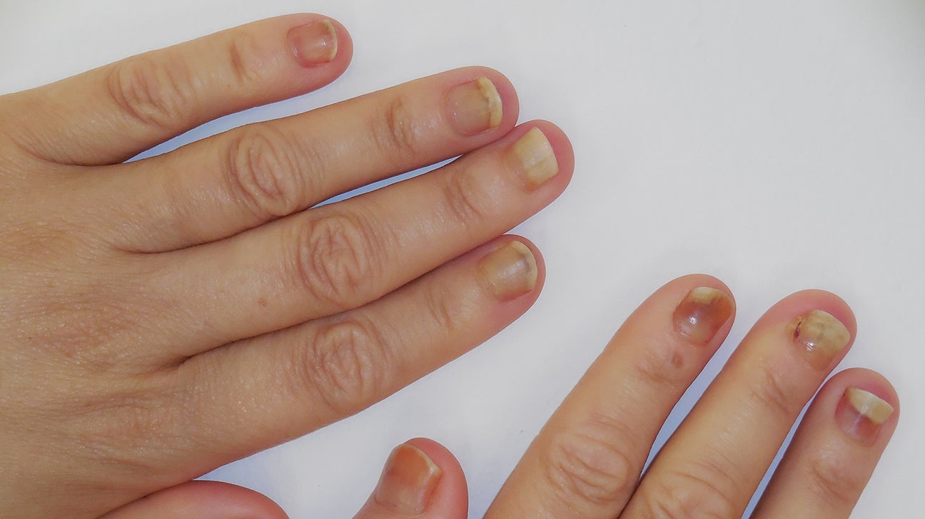 Nail bed injury: Pictures, types, and treatments