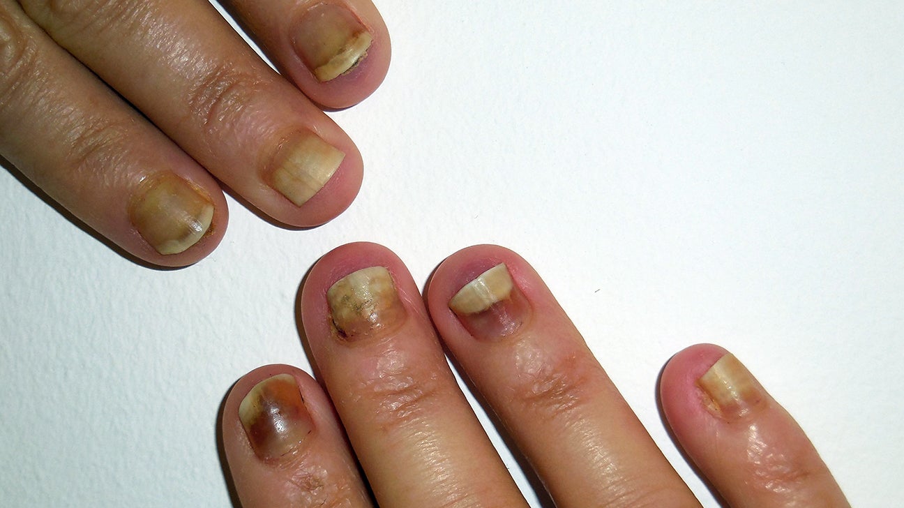 finger nail damage