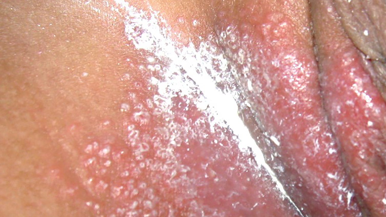 heat rash between buttocks