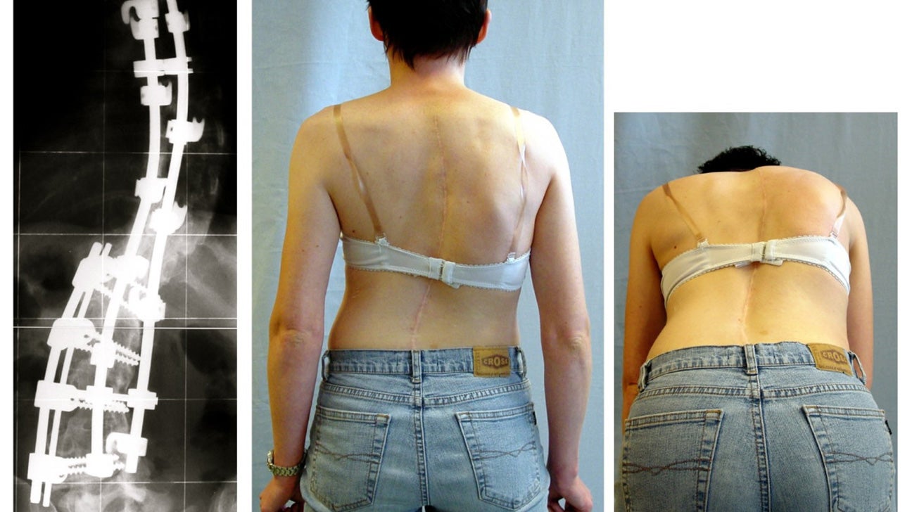 scoliosis treatment options