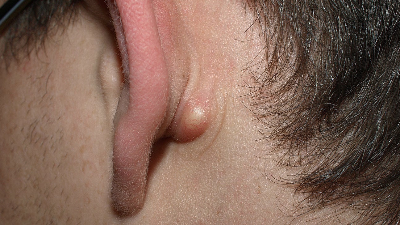 infected sebaceous cyst behind ear