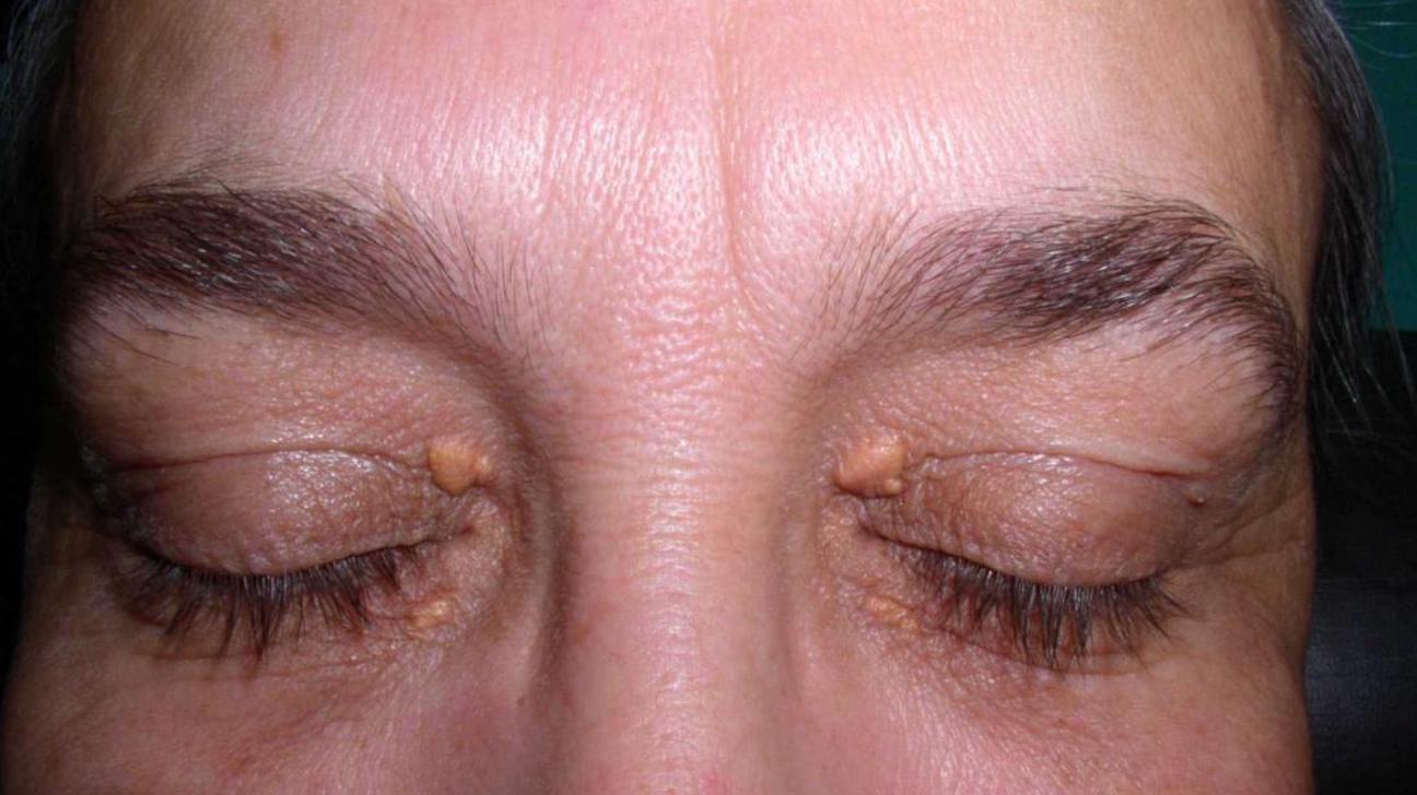 Milia under eyes: Causes, diagnosis, and treatment