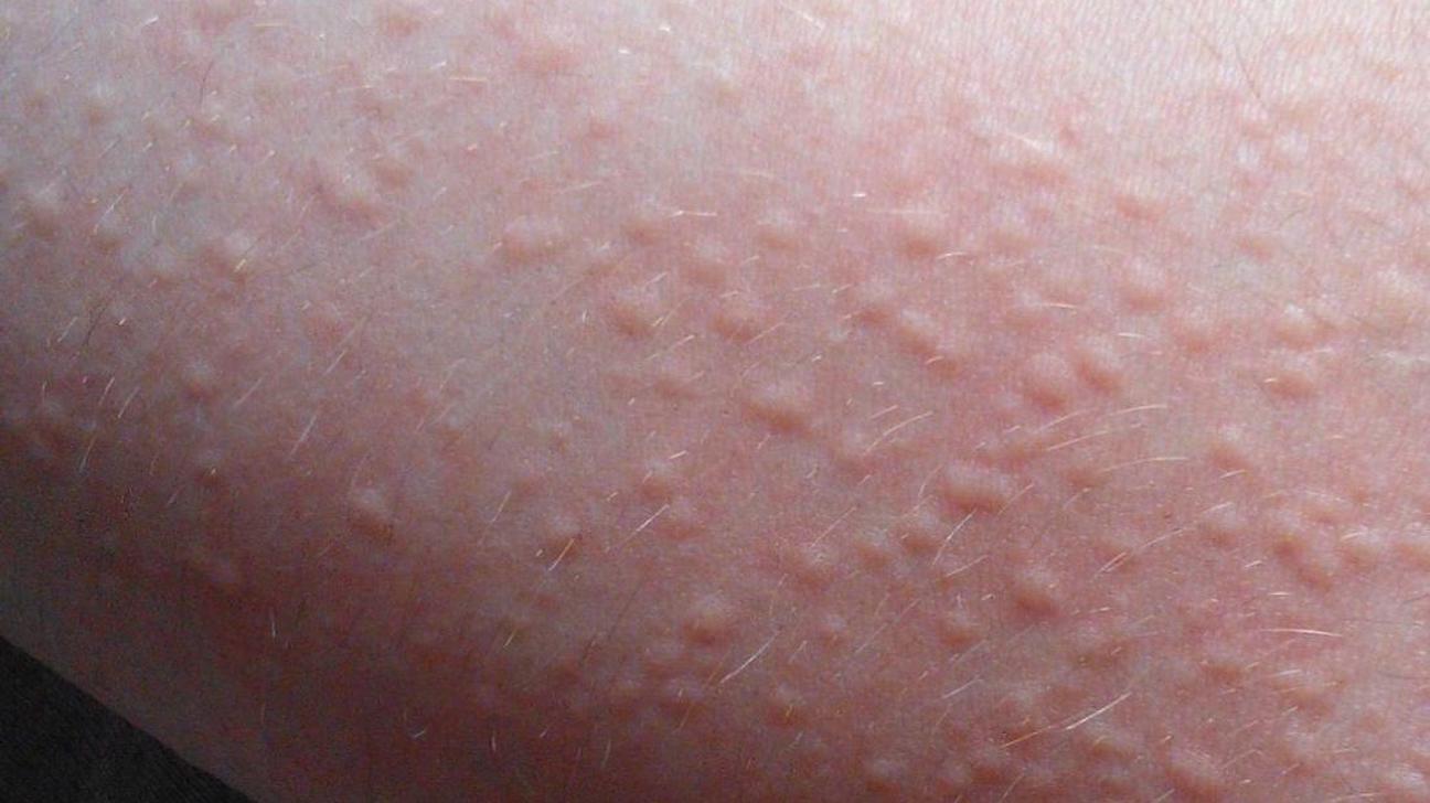 Cholinergic Urticaria Symptoms Treatment And Causes