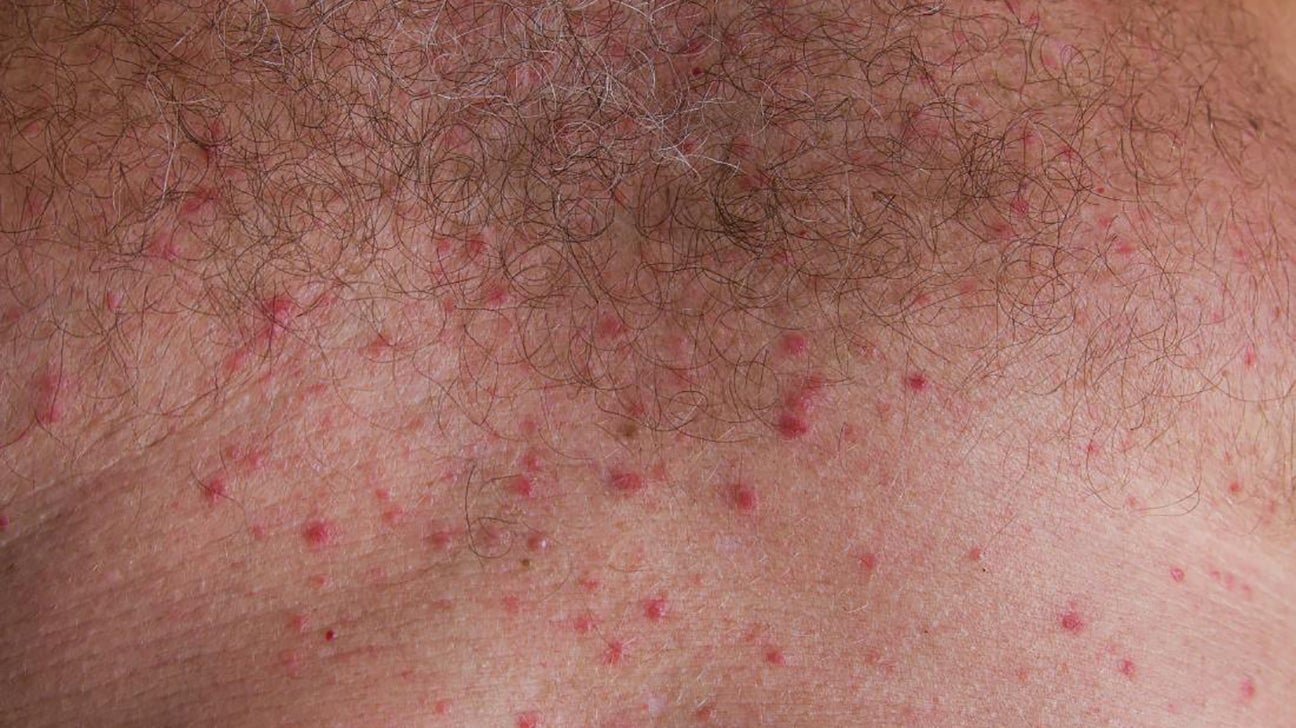 Rash Under Breast Causes Treatments And More