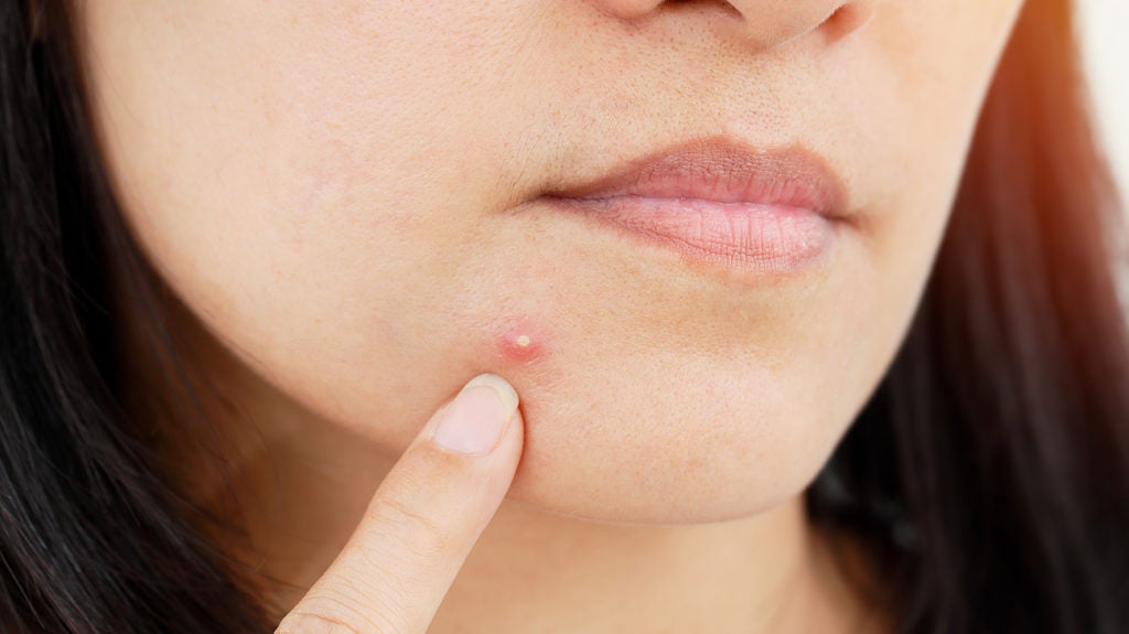 6 Steps to Heal a Big Pimple That Won't Go Away
